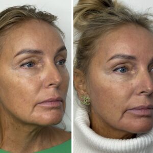 Noorendav mikronõelumine eksosoomidega